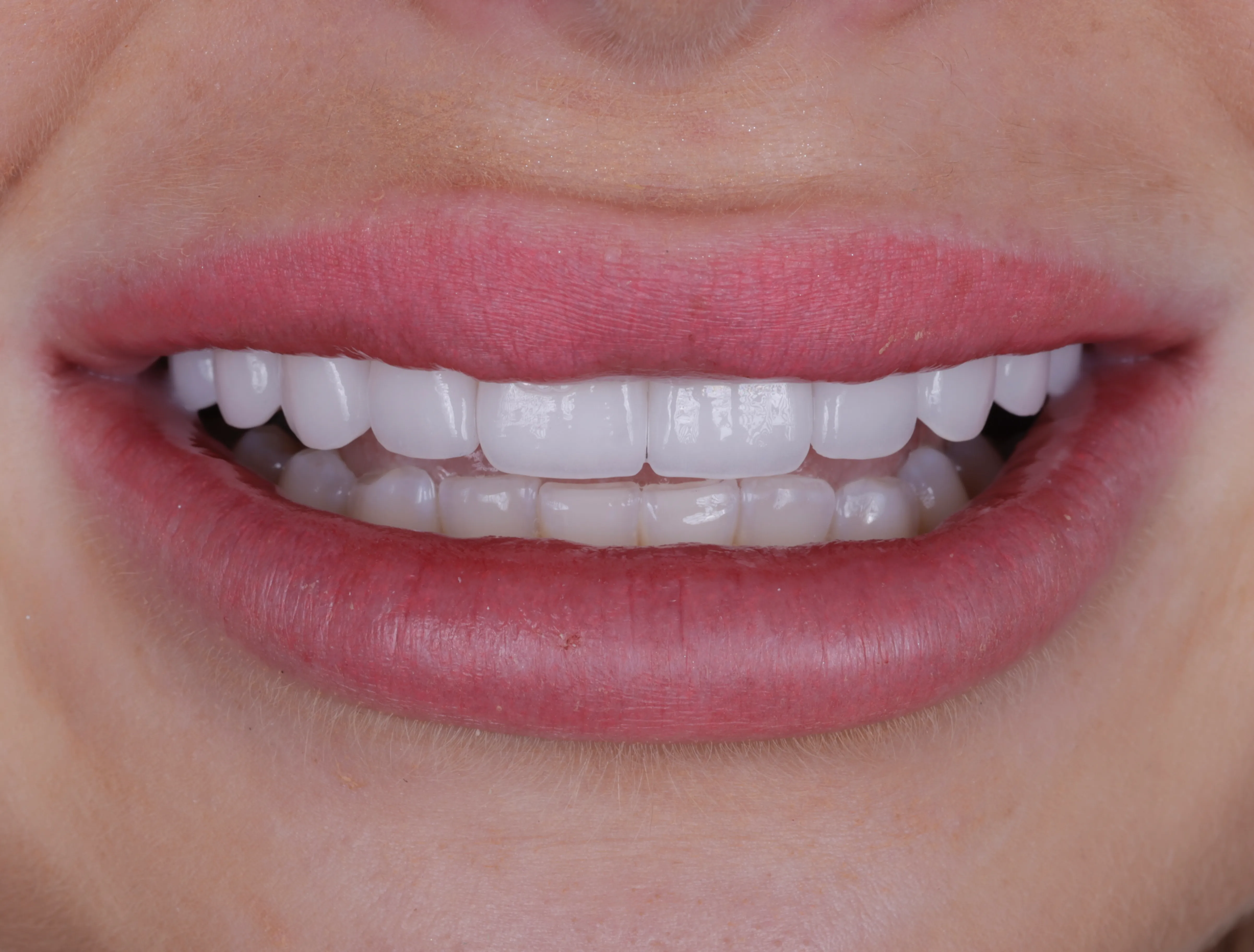 After smile makeover patient one