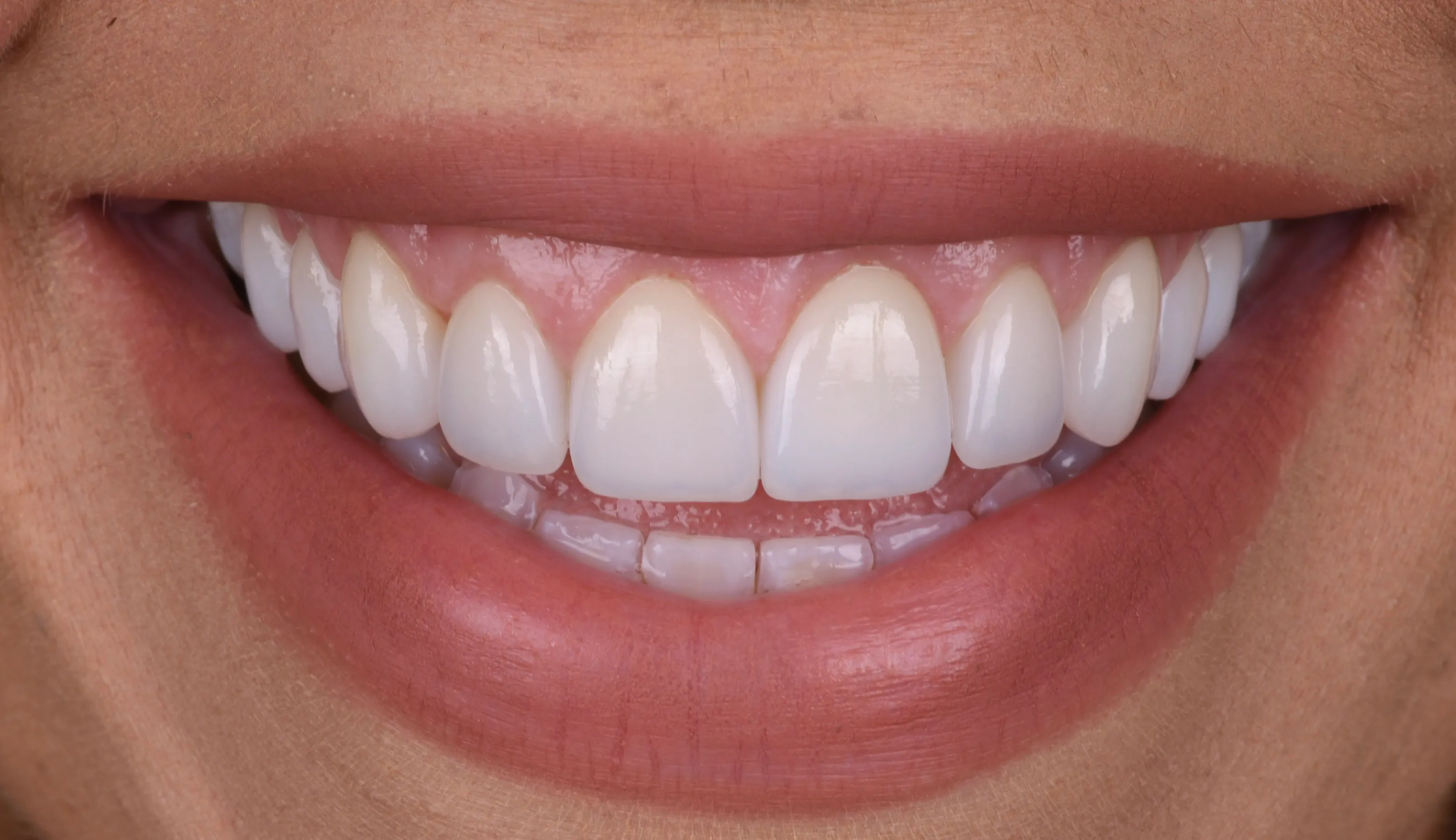 After smile makeover patient two