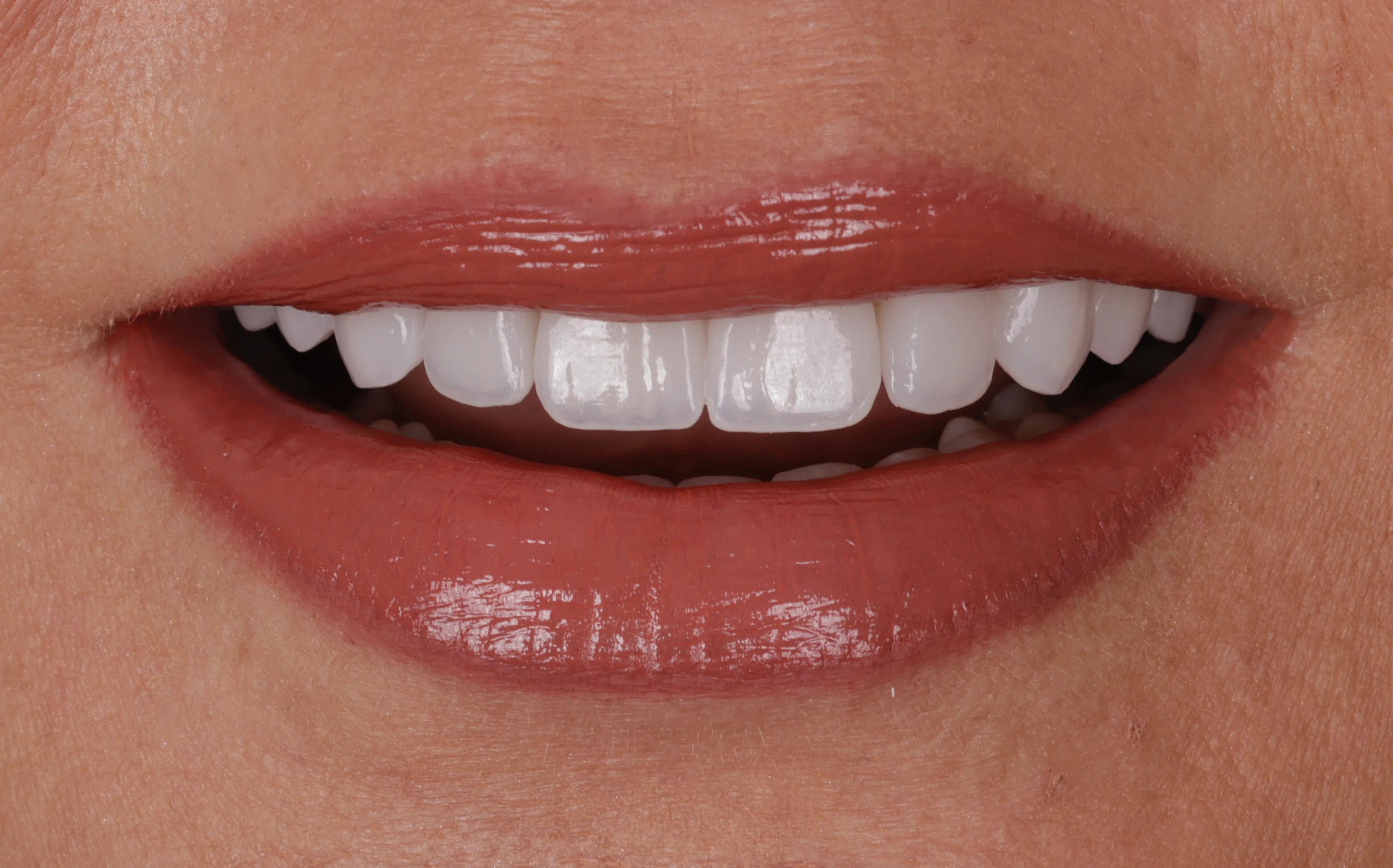 After smile makeover patient three