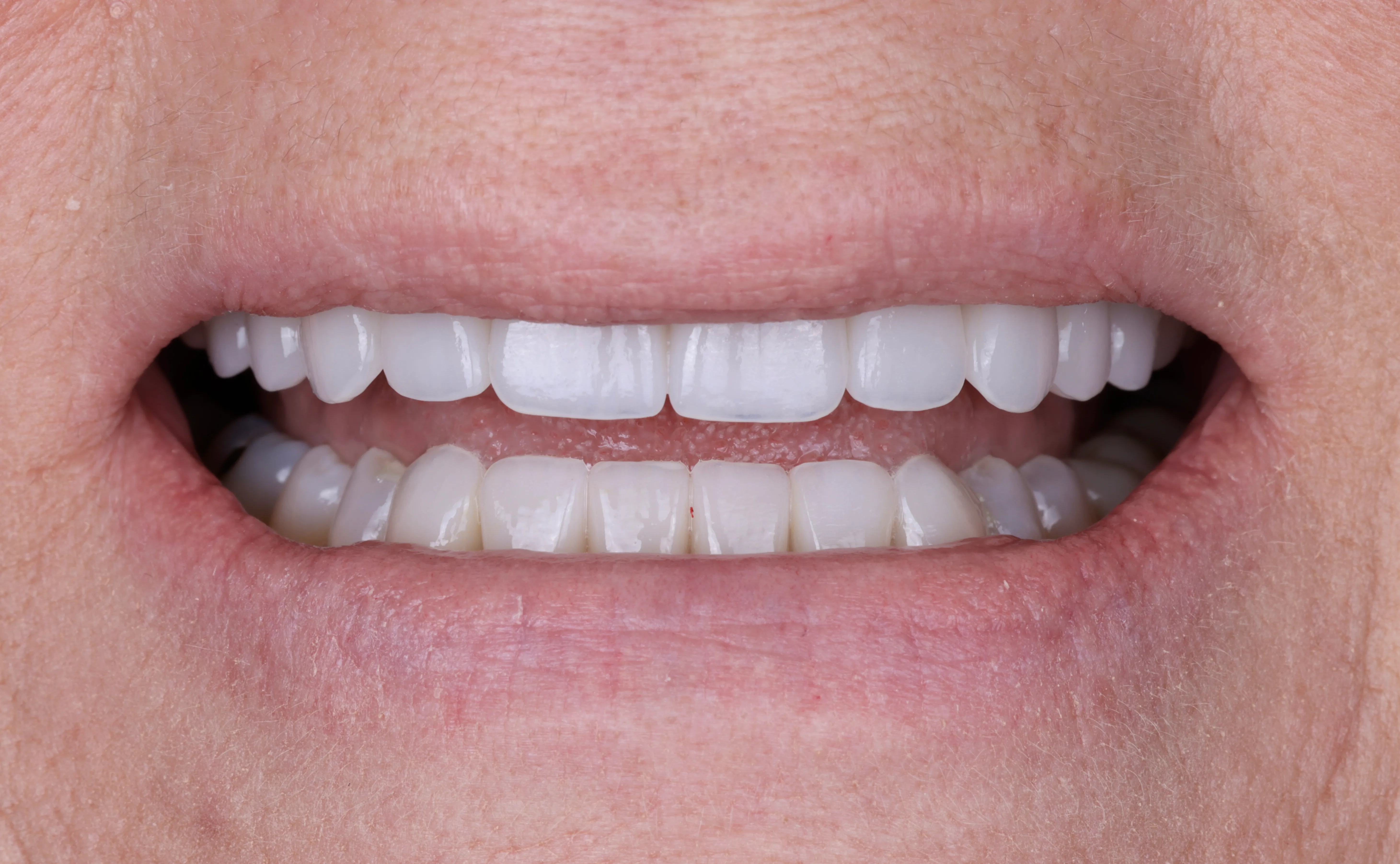 After smile makeover patient four showing restored balanced porcelain restorations