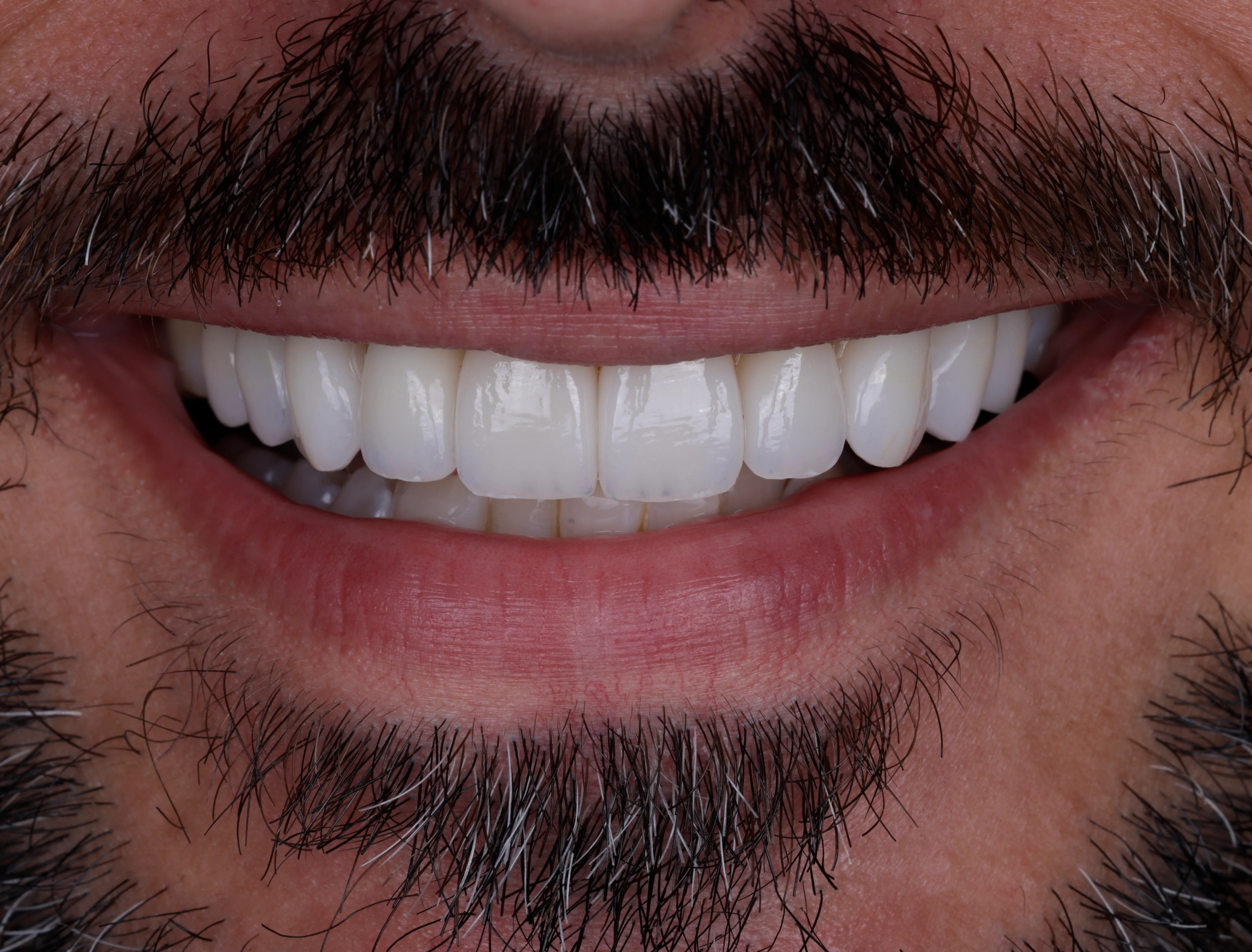 After smile makeover patient five showing repaired and refined front teeth