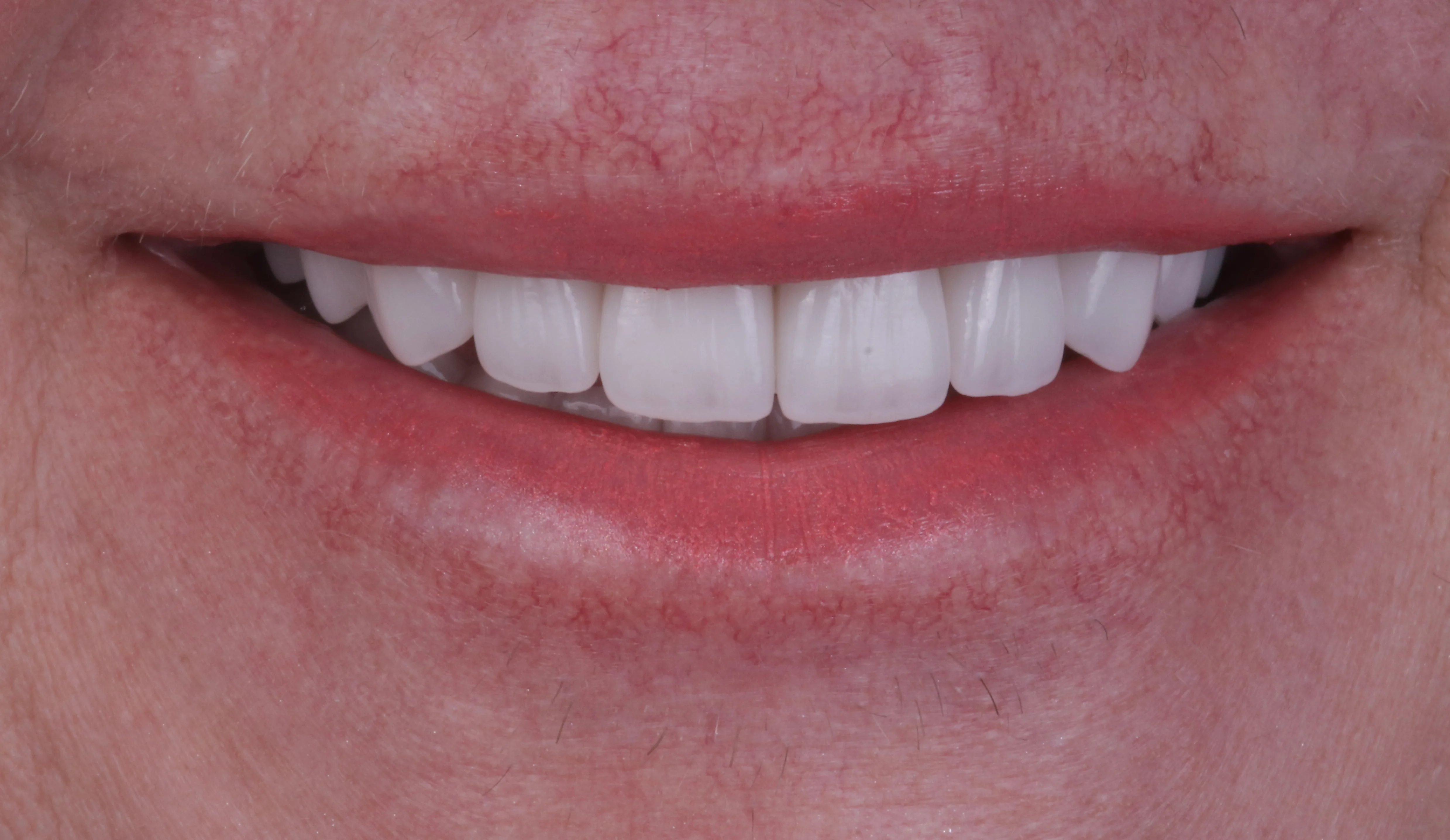 After smile makeover patient six showing natural masculine cosmetic result