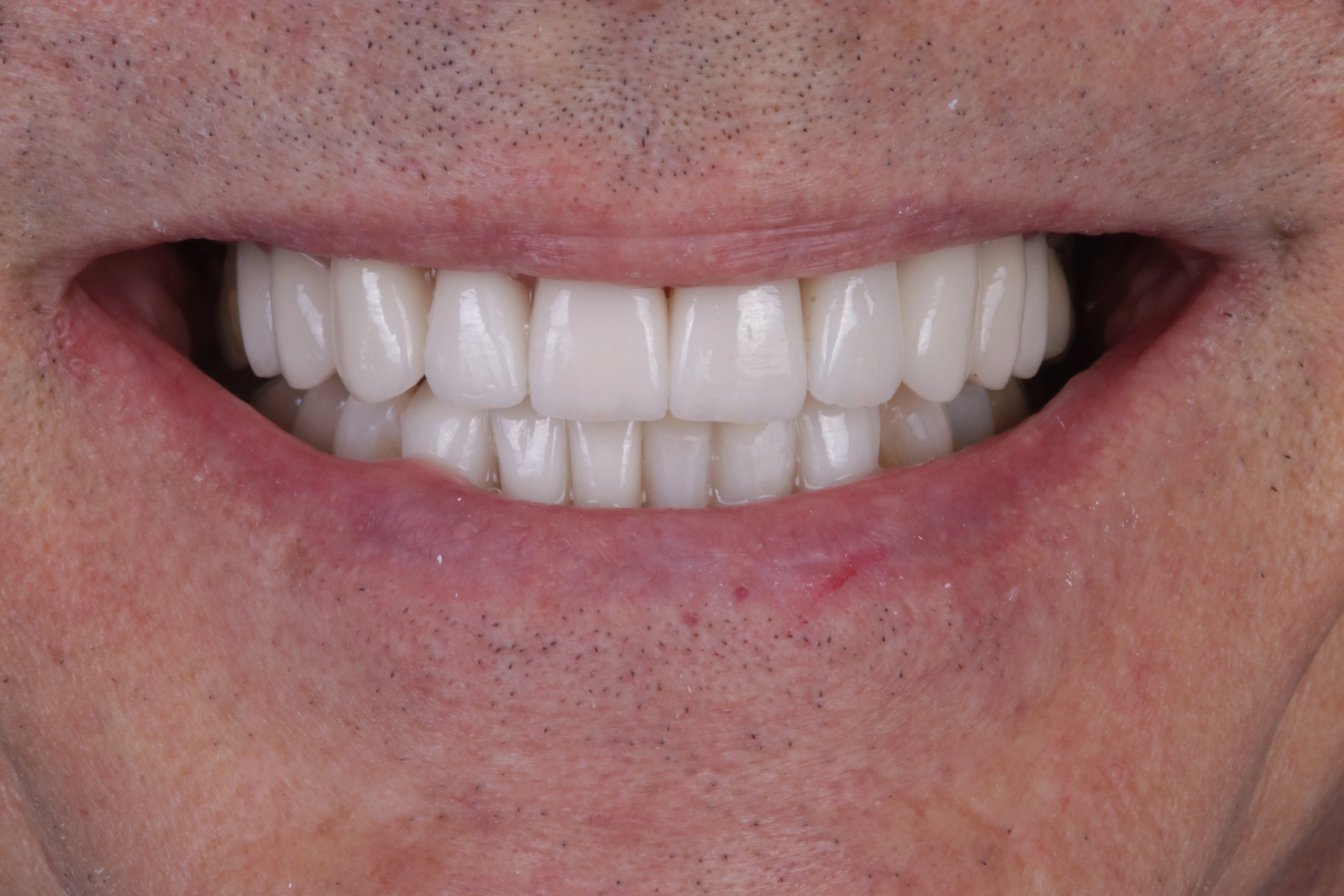 After smile makeover patient seven showing brighter balanced porcelain veneers