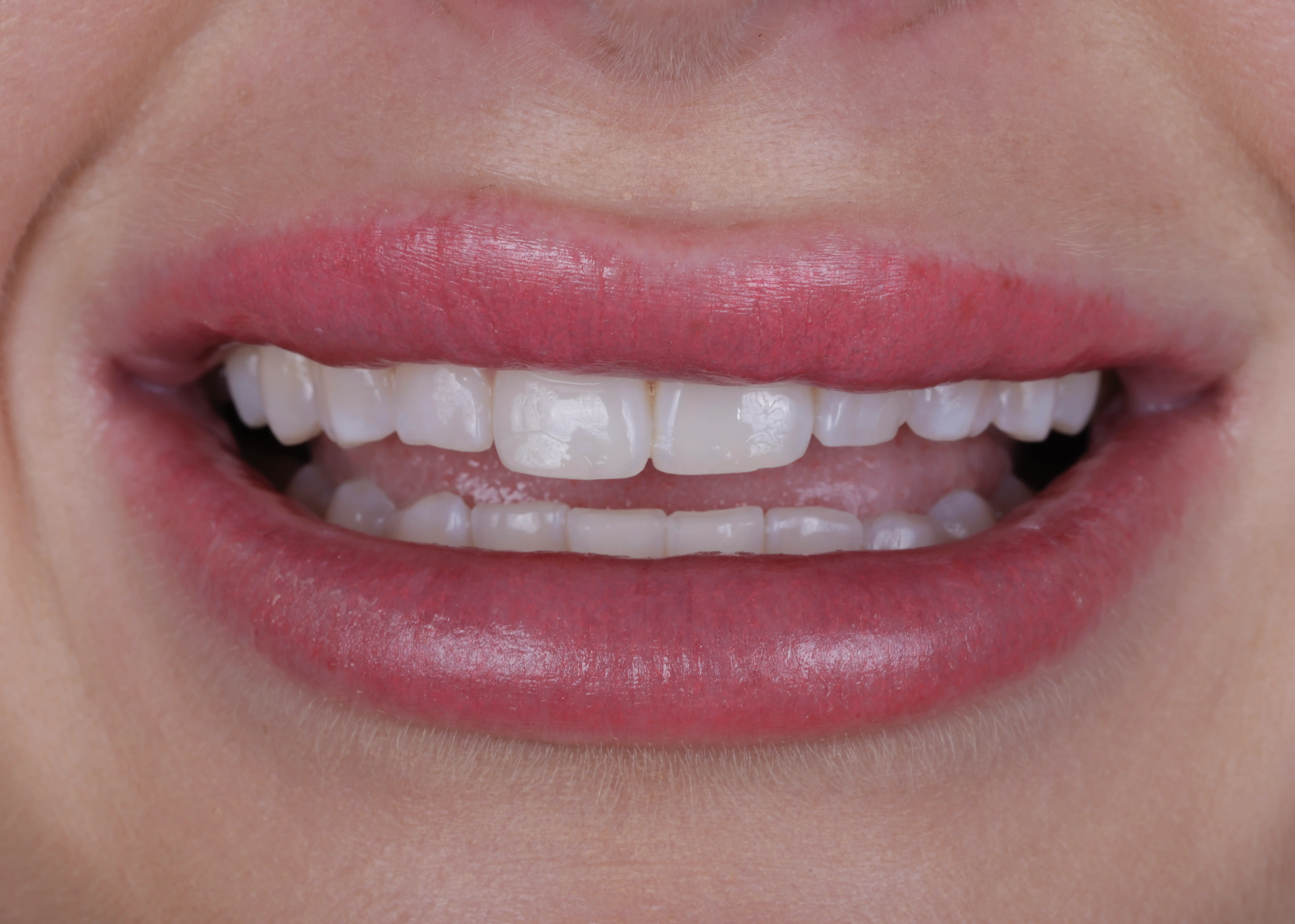 Before smile makeover patient one