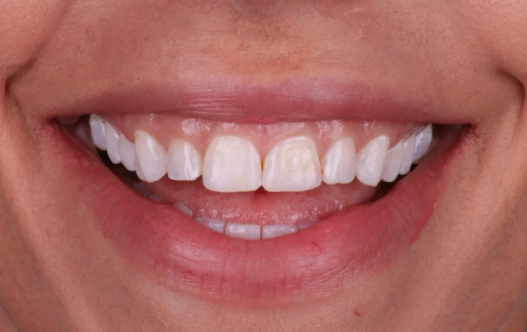 Before smile makeover patient two