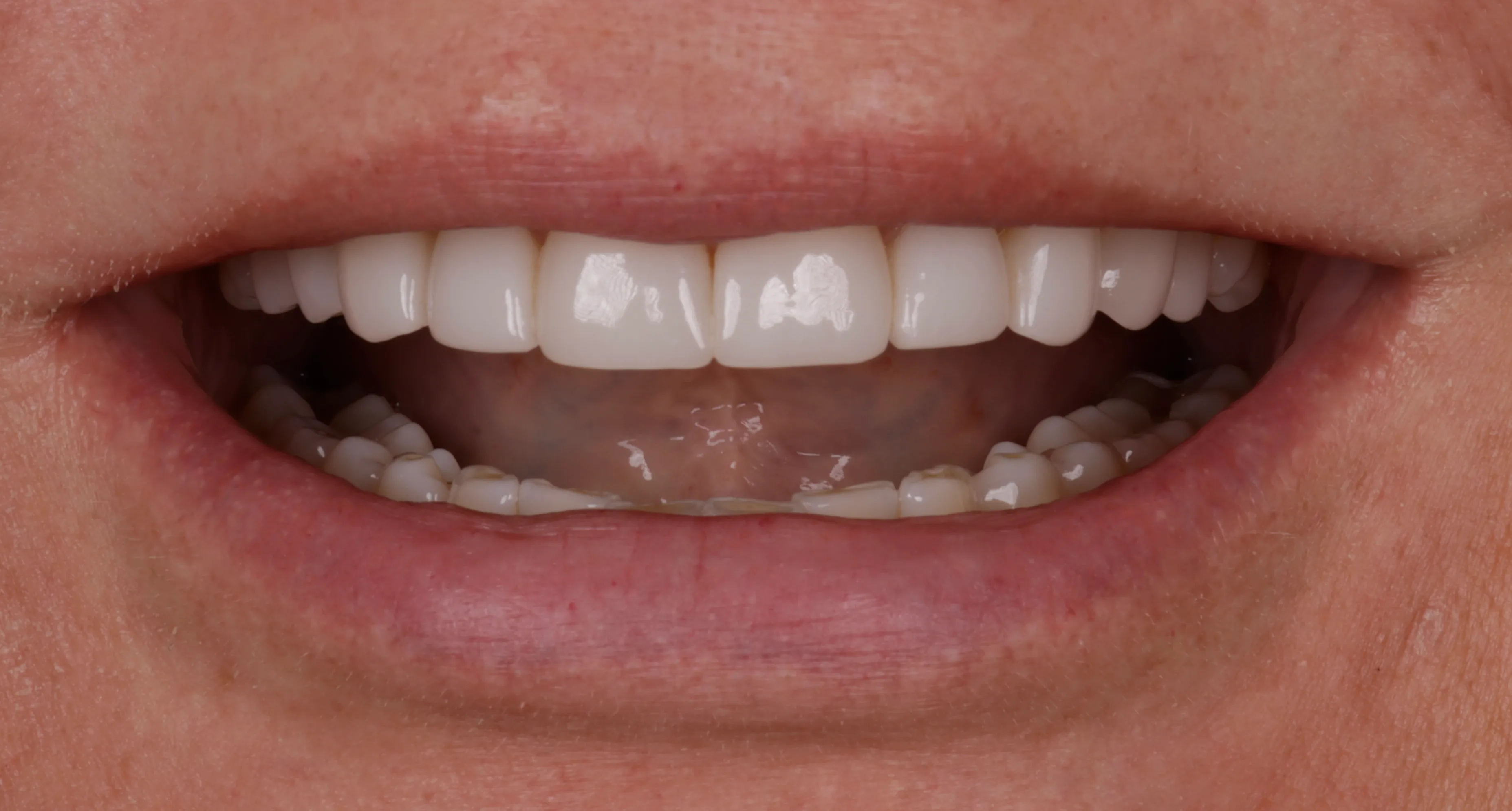 Before smile makeover patient three