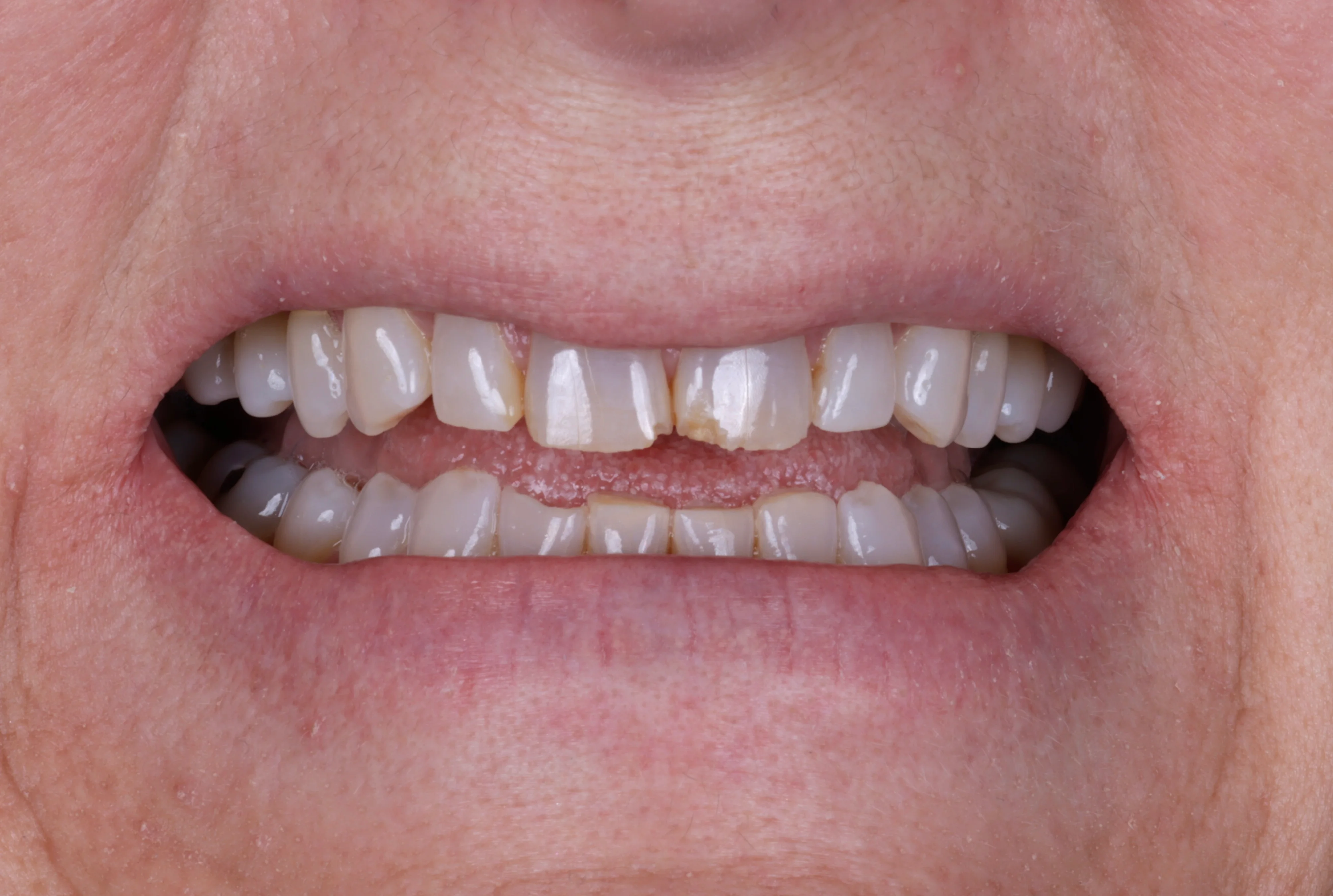 Before smile makeover patient four showing severe wear spacing and uneven teeth
