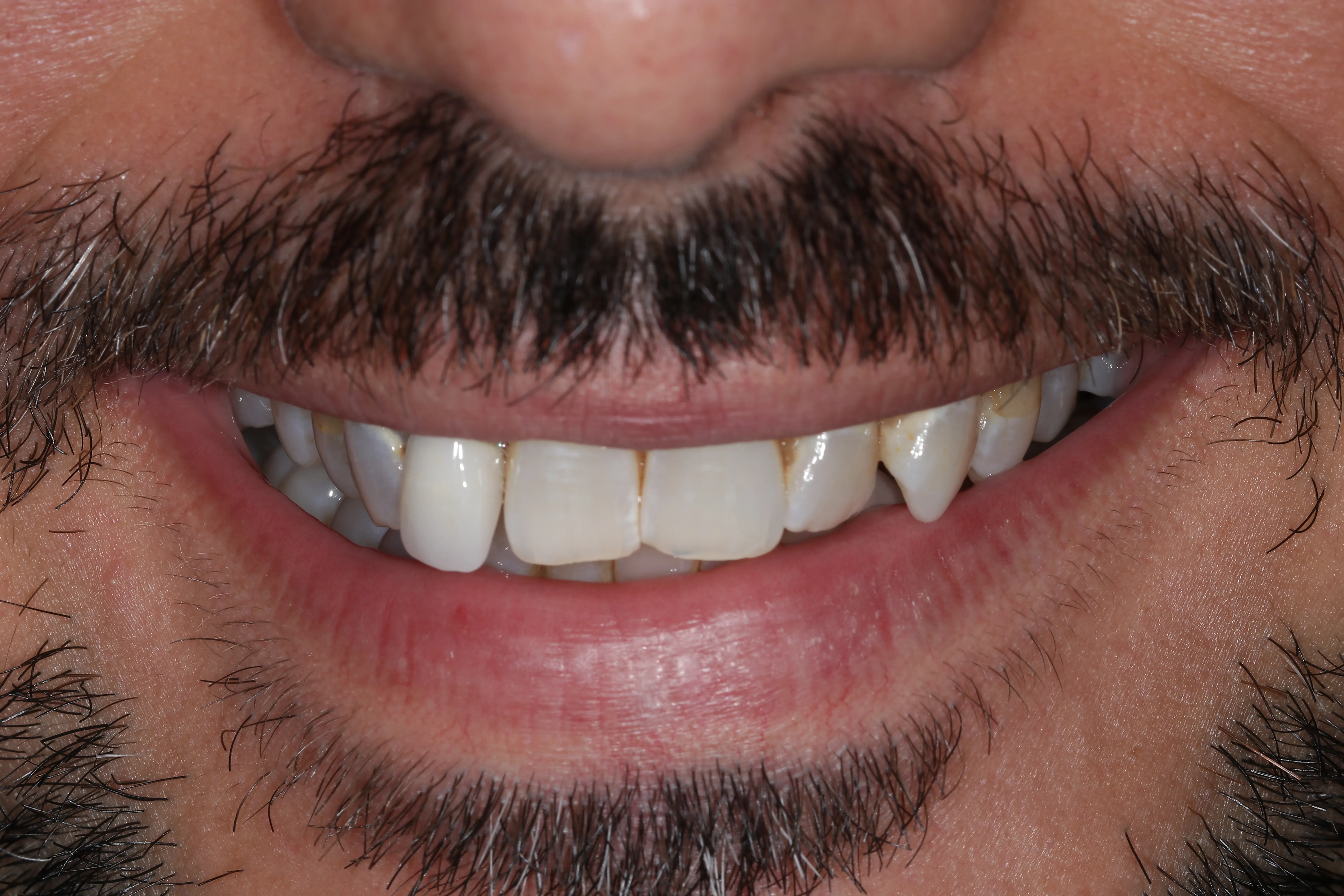 Before smile makeover patient five showing chipped and uneven front teeth