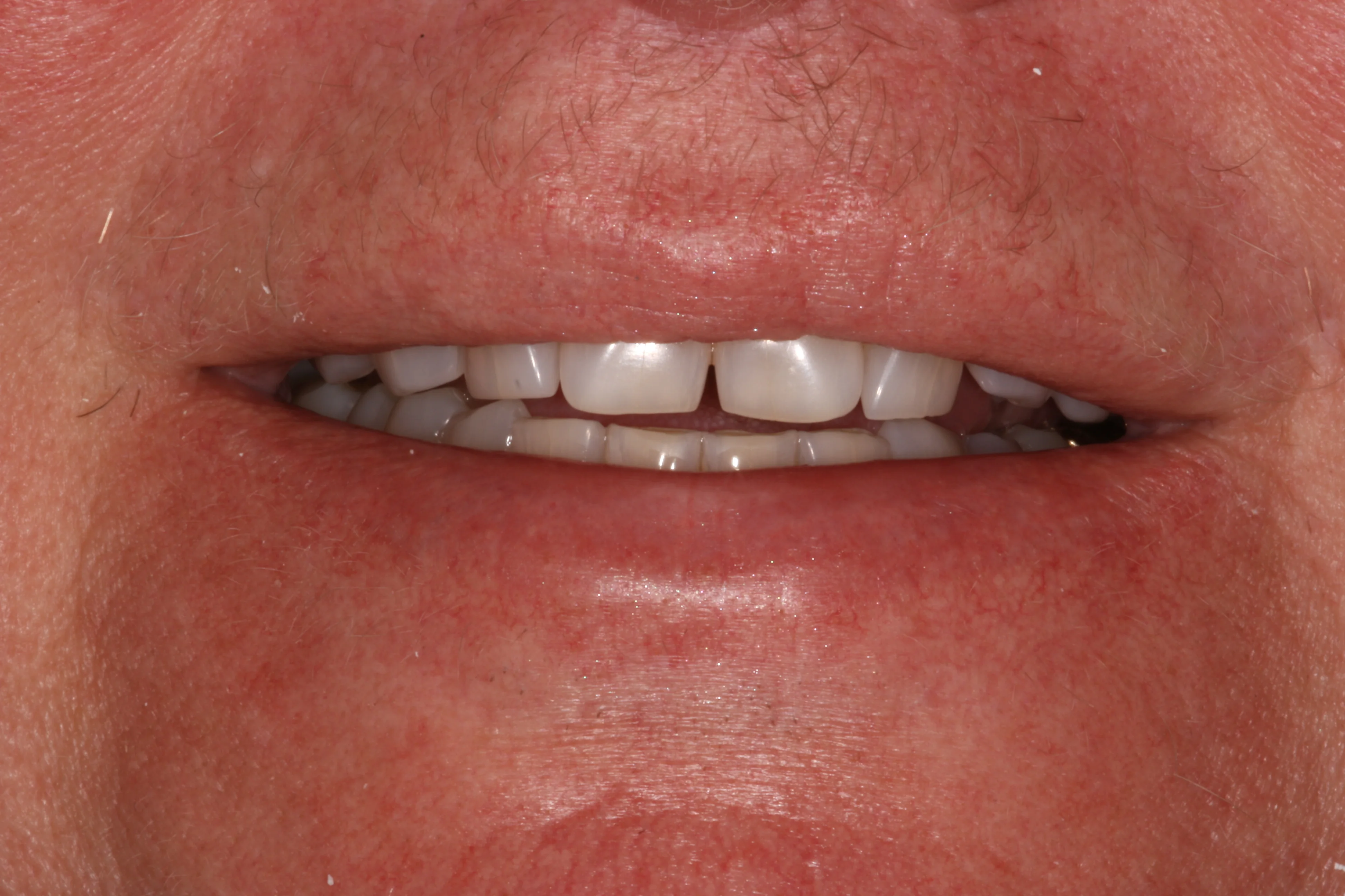Before smile makeover patient six showing uneven masculine smile and tooth position