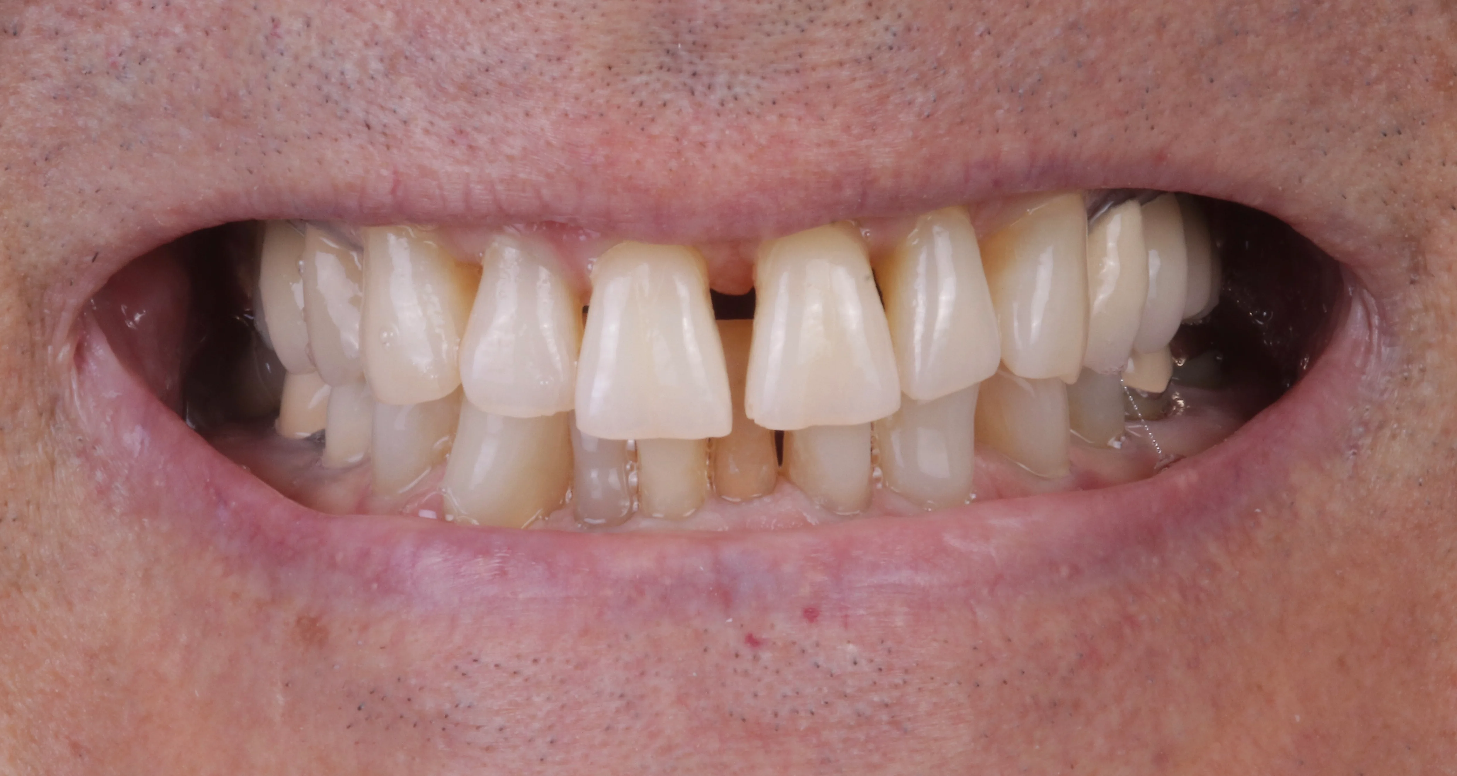 Before smile makeover patient seven showing yellow worn teeth and spacing
